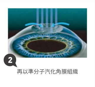 SFAIR TransPRK 步驟2:再以準分子汽化角膜組織