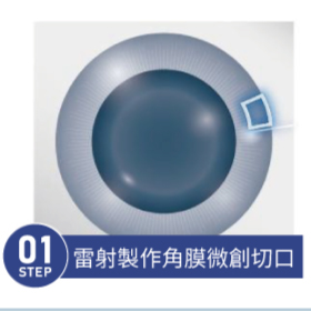 飛秒白內障 STEP 01