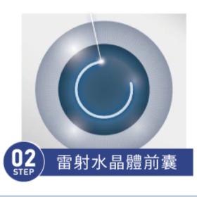 飛秒白內障 STEP 02