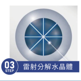 飛秒白內障 STEP 03