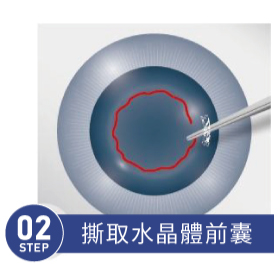 傳統白內障手術 STEP 02