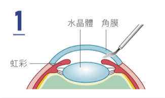 雷射製作角膜微創切口
