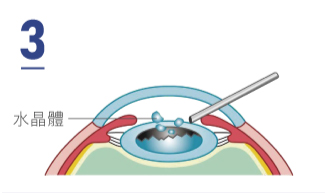 超音波乳化分解水晶體
